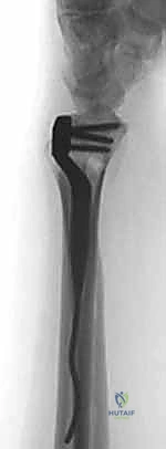 Illustration of tubercle of lister - Dr. Mohammed Hutaif