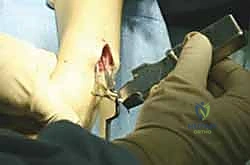 صورة توضيحية لـ تثبيت كسر الكعبرة البعيدة بالشريحة الظهرية: دليل المريض الشامل وخبرة الأستاذ الدكتور محمد هطيف في صنعاء