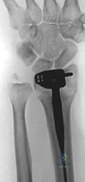 صورة توضيحية لـ تثبيت كسر الكعبرة البعيدة بالشريحة الظهرية: دليل المريض الشامل وخبرة الأستاذ الدكتور محمد هطيف في صنعاء