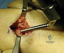 صورة طبية: تثبيت كسر الكعبرة البعيدة بالشريحة الظهرية: دليل المريض الشامل وخبرة الأستاذ الدكتور محمد هطيف في صنعاء