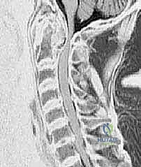صورة توضيحية لـ تثبيت الفقرات العنقية C1-C2