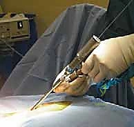 تحديد المعالم التشريحية أثناء الجراحة