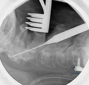 إدخال المسامير وتحديد المسار الدقيق