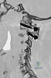 صورة توضيحية لـ تثبيت الفقرات العنقية C1-C2: الحل الجراحي المتقدم لاستقرار الرقبة في صنعاء مع الأستاذ الدكتور محمد هطيف