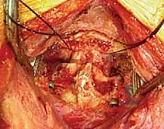 صورة توضيحية لـ تثبيت الفقرات العنقية C1-C2: الحل الجراحي المتقدم لاستقرار الرقبة في صنعاء مع الأستاذ الدكتور محمد هطيف