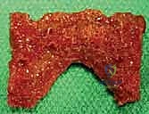 Cervical Masterclass: Posterior C1-C2 Fusion with Transarticular and Articular Mass Fixation