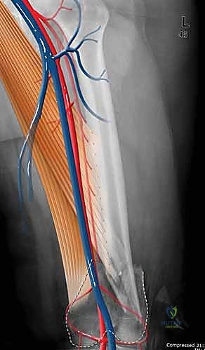 توضيح المحور الميكانيكي والتشريحي