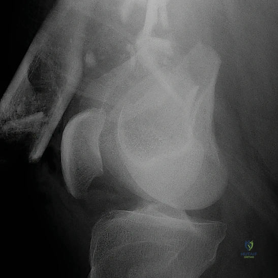 تأثير الكسر على السطح المفصلي