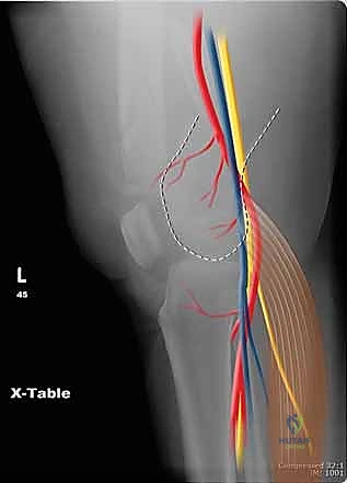 انحراف العظم بسبب الإصابة