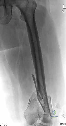 تشوه في استقامة الساق