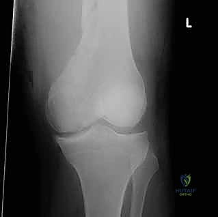 فحص سريري للطرف المصاب