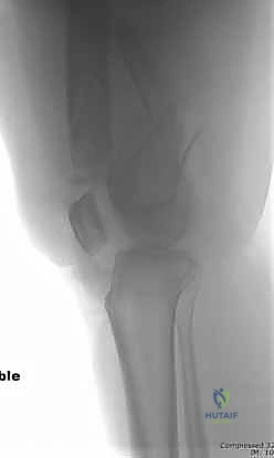 صورة مقطعية لتفاصيل الكسر