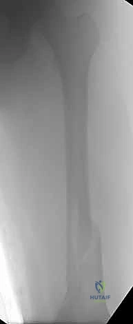 تورم ملحوظ في الركبة