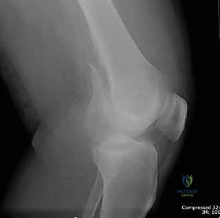 أشعة سينية توضح الكسر