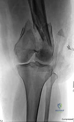 تحديد مسار الشرائح الجراحية