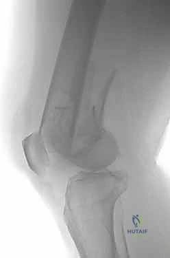 التخطيط لما قبل العملية