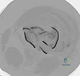 تحليل مدى تفتت العظم