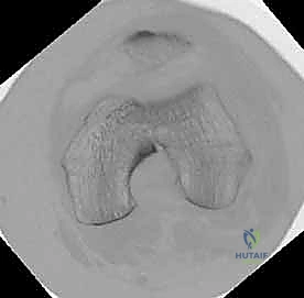 الفتح الجراحي الدقيق