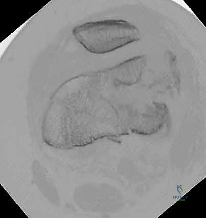 التعقيم الجراحي الشامل