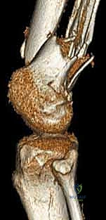 كشف منطقة الكسر