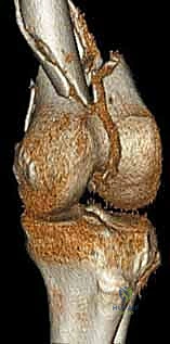 الوصول إلى السطح المفصلي