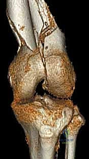 إبعاد الأنسجة الرخوة بلطف