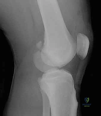 تثبيت المفصل بأسلاك كيرشنر المؤقتة