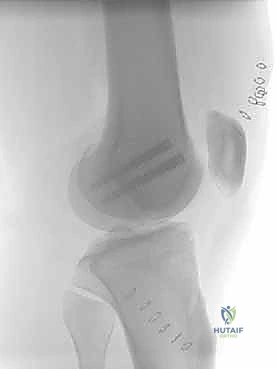 التأكد من استقامة السطح المفصلي