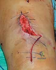 مراجعة المحاور الميكانيكية أثناء الجراحة