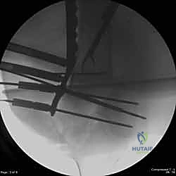 صورة توضيحية لـ كسور عظم الفخذ البعيدة: دليل شامل للعلاج والتعافي مع الأستاذ الدكتور محمد هطيف