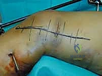 صورة توضيحية لـ كسور عظم الفخذ البعيدة: دليل شامل للعلاج والتعافي مع الأستاذ الدكتور محمد هطيف