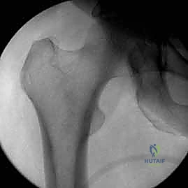 صورة طبية: كسور عظم الفخذ البعيدة: دليل شامل للعلاج والتعافي مع الأستاذ الدكتور محمد هطيف