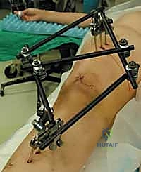 صورة طبية: كسور عظم الفخذ البعيدة: دليل شامل للعلاج والتعافي مع الأستاذ الدكتور محمد هطيف