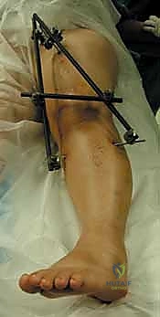 صورة طبية: كسور عظم الفخذ البعيدة: دليل شامل للعلاج والتعافي مع الأستاذ الدكتور محمد هطيف