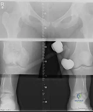 شريحة التيتانيوم مستقرة في مكانها