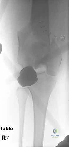 صورة طبية: كسور عظم الفخذ البعيدة: دليل شامل للعلاج والتعافي مع الأستاذ الدكتور محمد هطيف