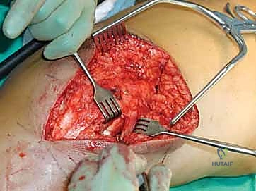 صورة شعاعية لموضع الشريحة