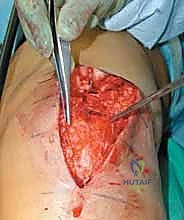 إضافة مسامير إضافية للثبات