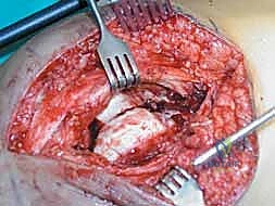 صورة توضيحية لـ كسور عظم الفخذ البعيدة: دليل شامل للعلاج والتعافي مع الأستاذ الدكتور محمد هطيف