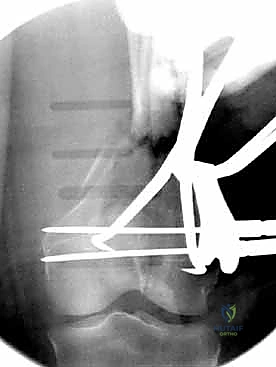 صورة شعاعية للتثبيت المزدوج