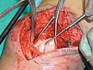 خياطة الأنسجة العميقة