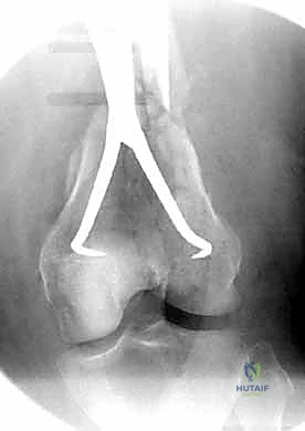 صورة توضيحية لـ كسور عظم الفخذ البعيدة: دليل شامل للعلاج والتعافي مع الأستاذ الدكتور محمد هطيف