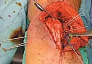 صورة طبية: كسور عظم الفخذ البعيدة: دليل شامل للعلاج والتعافي مع الأستاذ الدكتور محمد هطيف