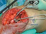 صورة طبية: كسور عظم الفخذ البعيدة: دليل شامل للعلاج والتعافي مع الأستاذ الدكتور محمد هطيف