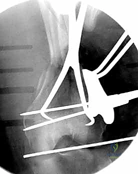 صورة طبية: كسور عظم الفخذ البعيدة: دليل شامل للعلاج والتعافي مع الأستاذ الدكتور محمد هطيف