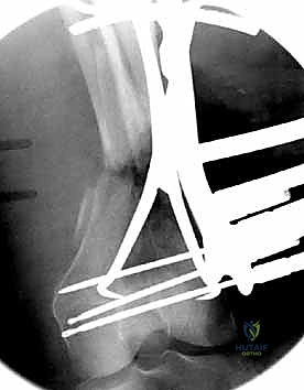 صورة توضيحية لـ كسور عظم الفخذ البعيدة: دليل شامل للعلاج والتعافي مع الأستاذ الدكتور محمد هطيف