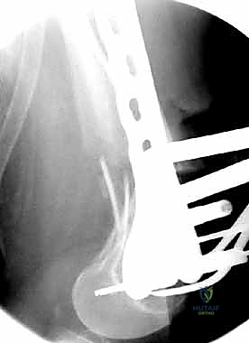 المظهر النهائي للتثبيت الداخلي