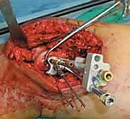 صورة طبية: كسور عظم الفخذ البعيدة: دليل شامل للعلاج والتعافي مع الأستاذ الدكتور محمد هطيف