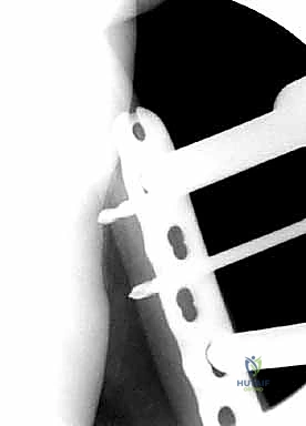 صورة طبية: كسور عظم الفخذ البعيدة: دليل شامل للعلاج والتعافي مع الأستاذ الدكتور محمد هطيف