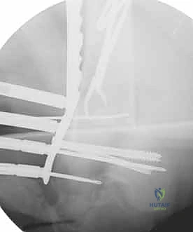 صورة طبية: كسور عظم الفخذ البعيدة: دليل شامل للعلاج والتعافي مع الأستاذ الدكتور محمد هطيف